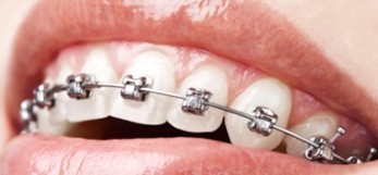 Scopri di più sull'articolo Ortodonzia fissa, mobile e invisibile
